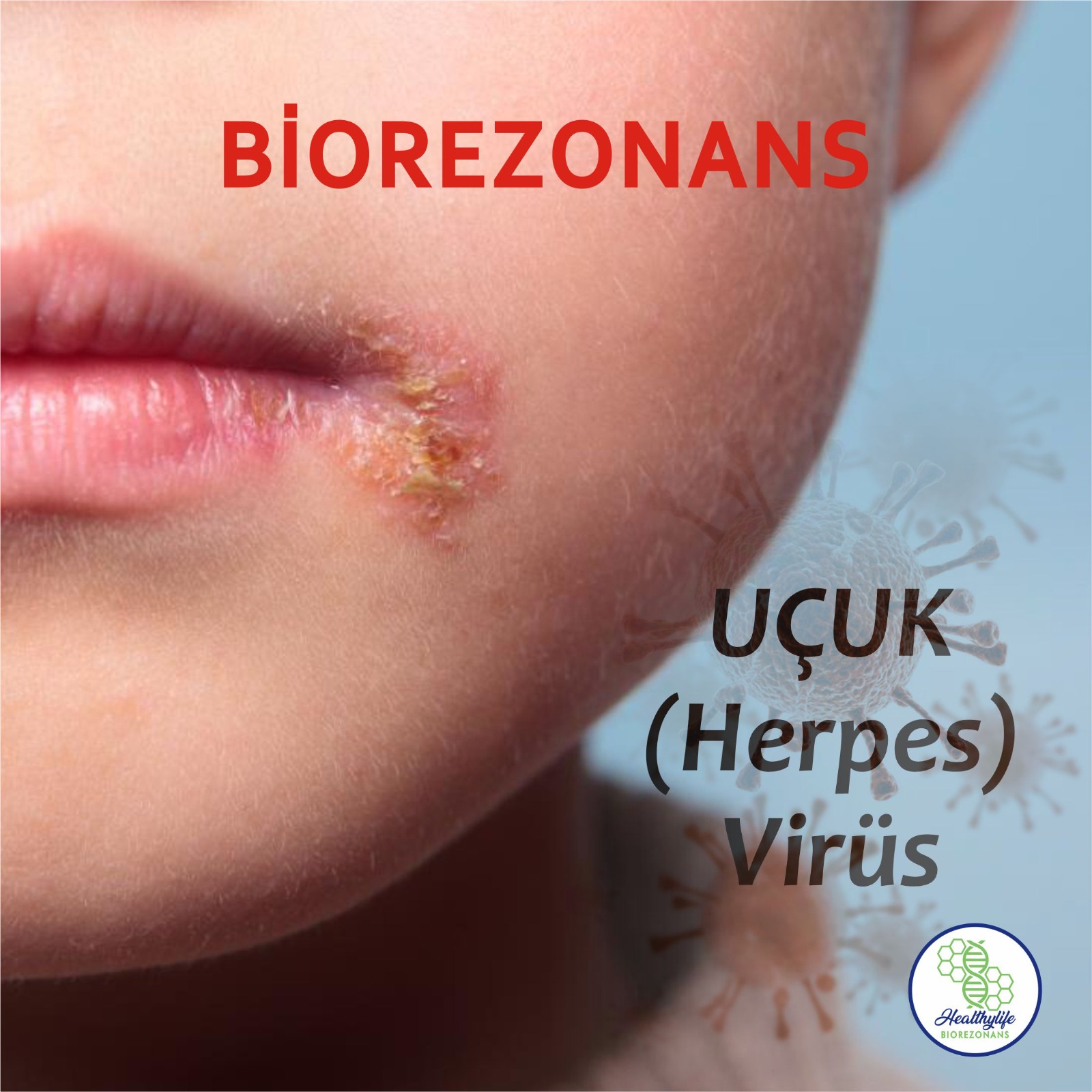 Uçuk (Herpes) Virüs